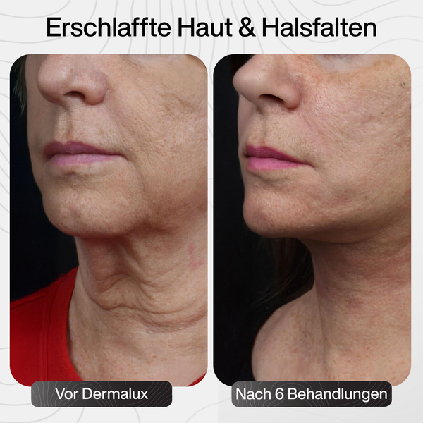 Hauterschlaffung & Halsfalten