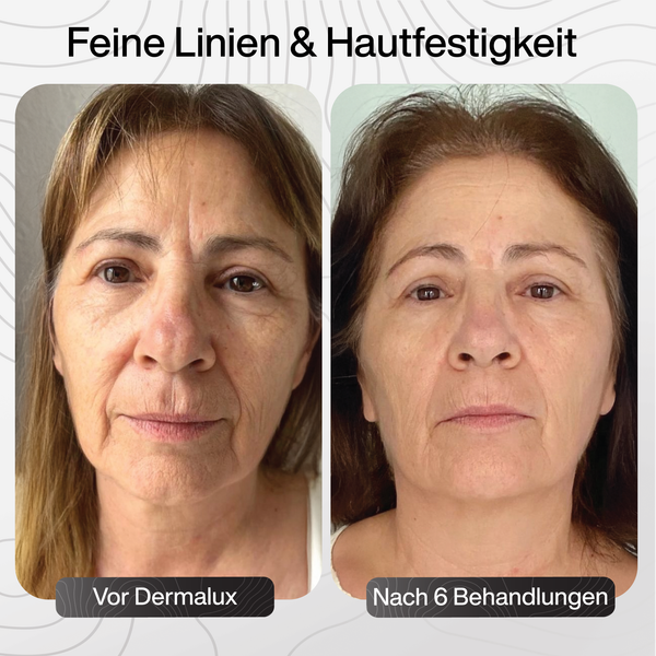 Tiefe Narben & vergrößerte Poren