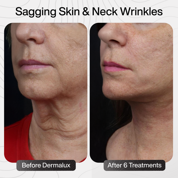 Sagging Skin & Neck Wrinkles