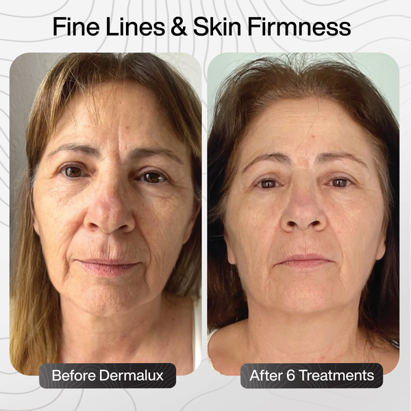 Fine Lines & Skin Firmness